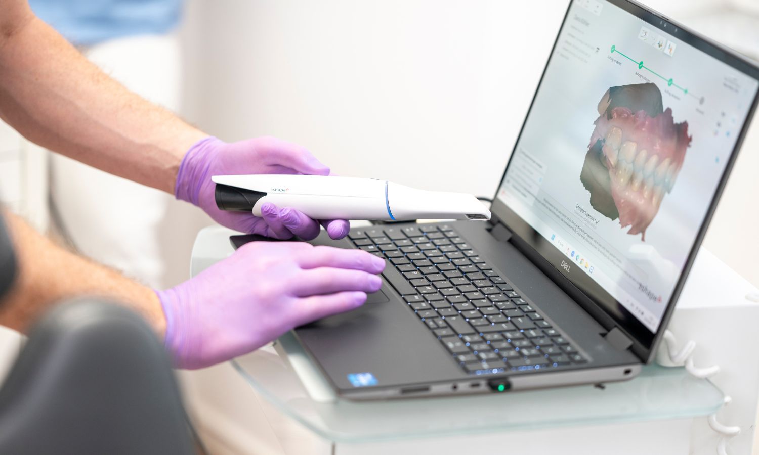 Intraoralscanner für digitale Abformungen